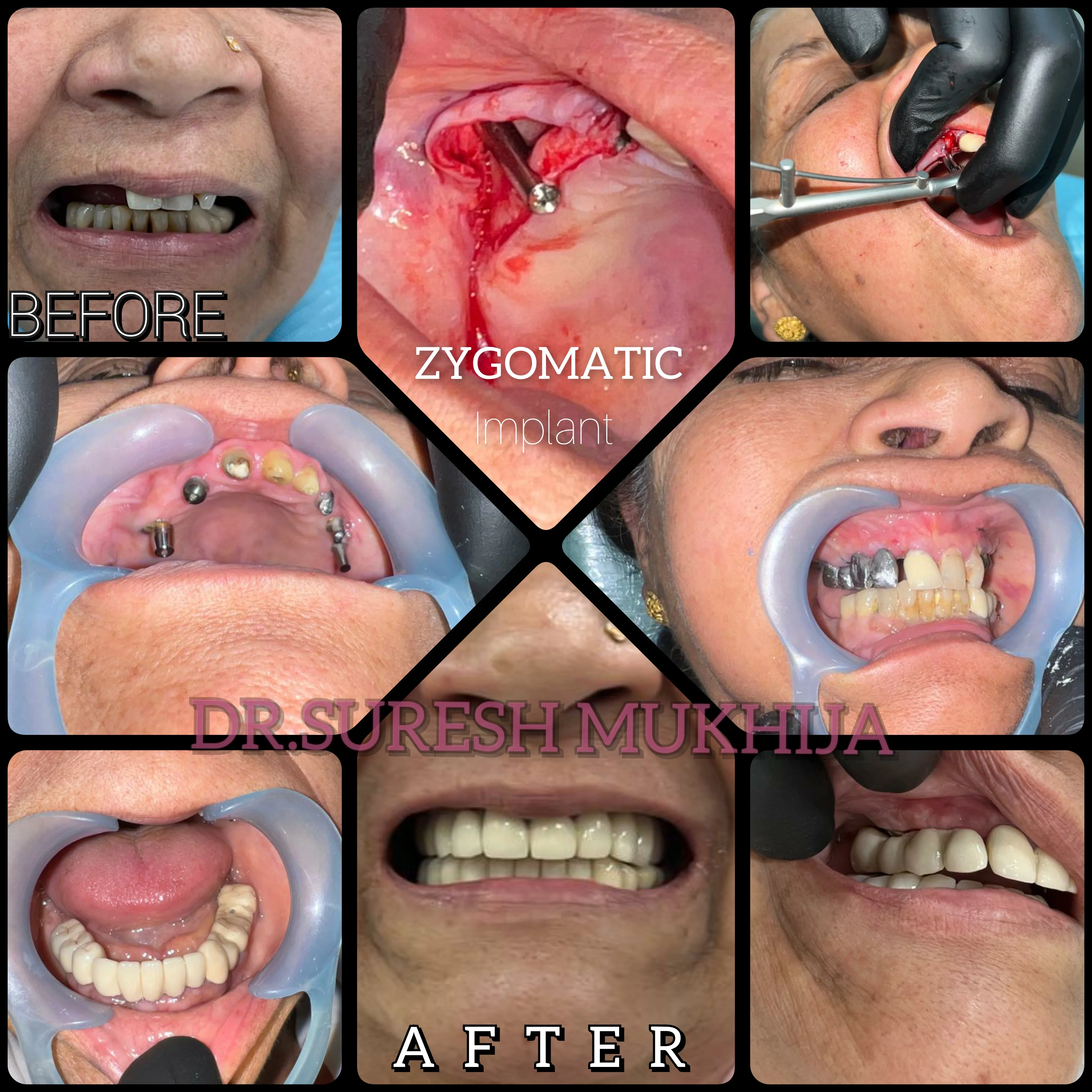 zygomatic implants