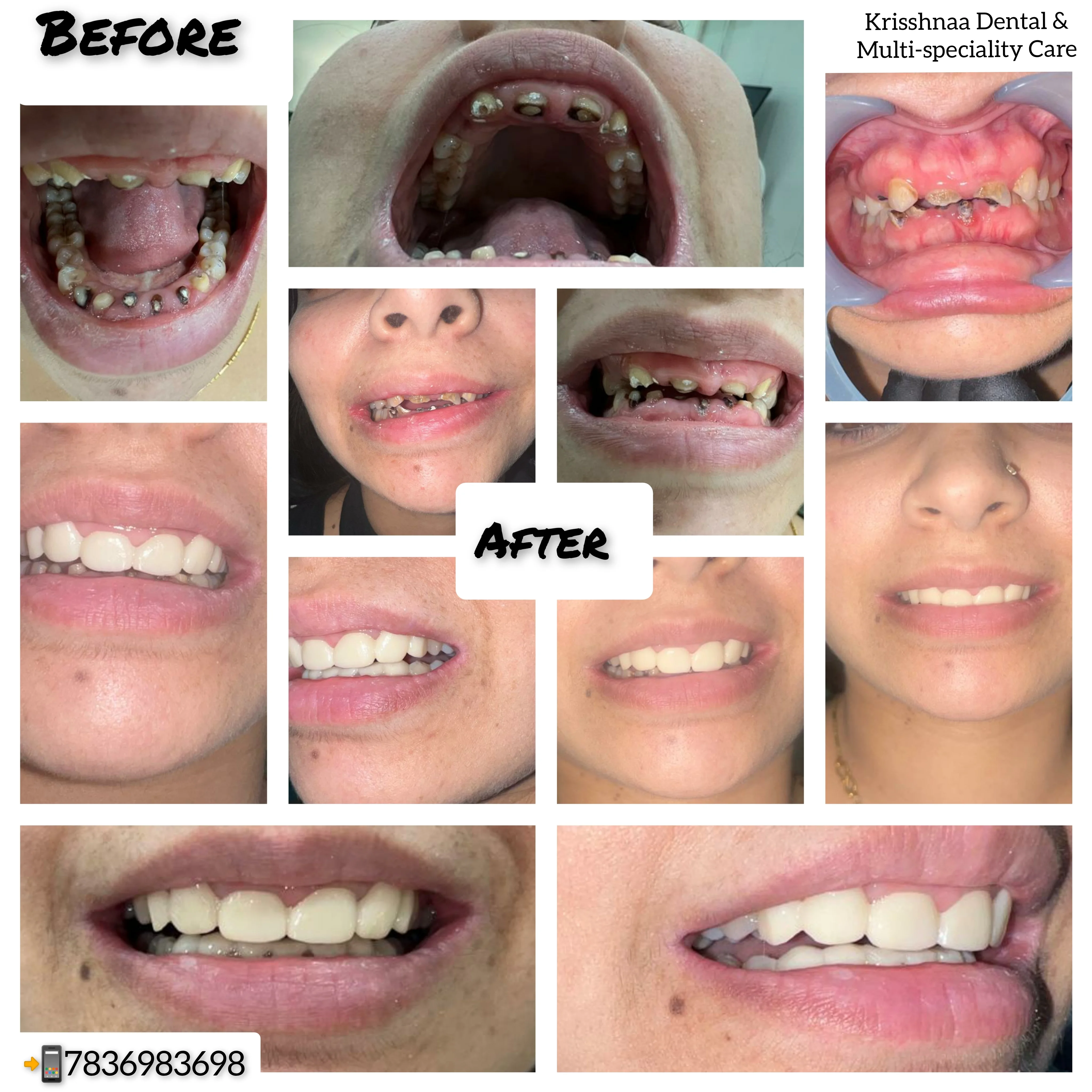 Smile makeover