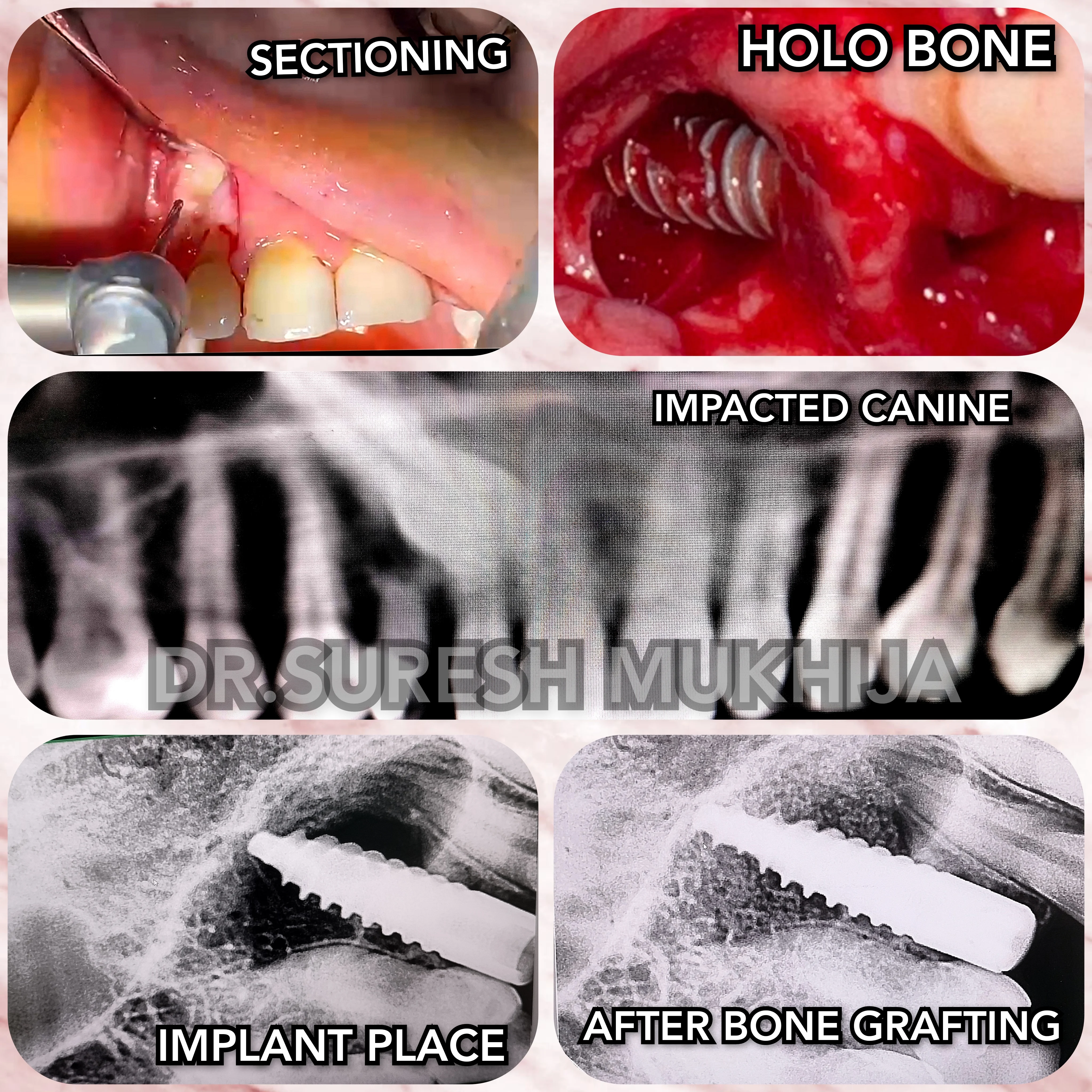 surgical removal of palatally impacted canine