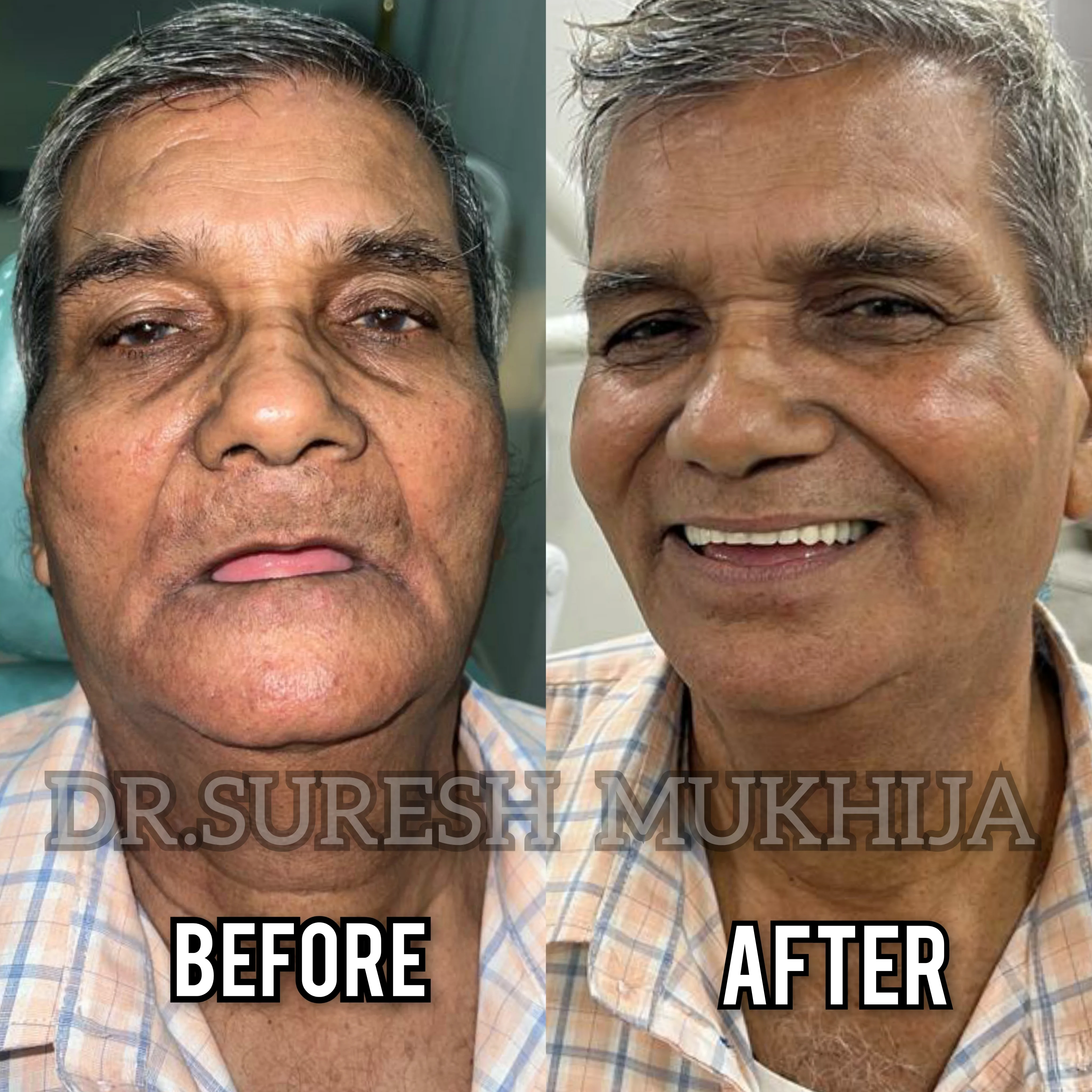 Implant supported overdenture