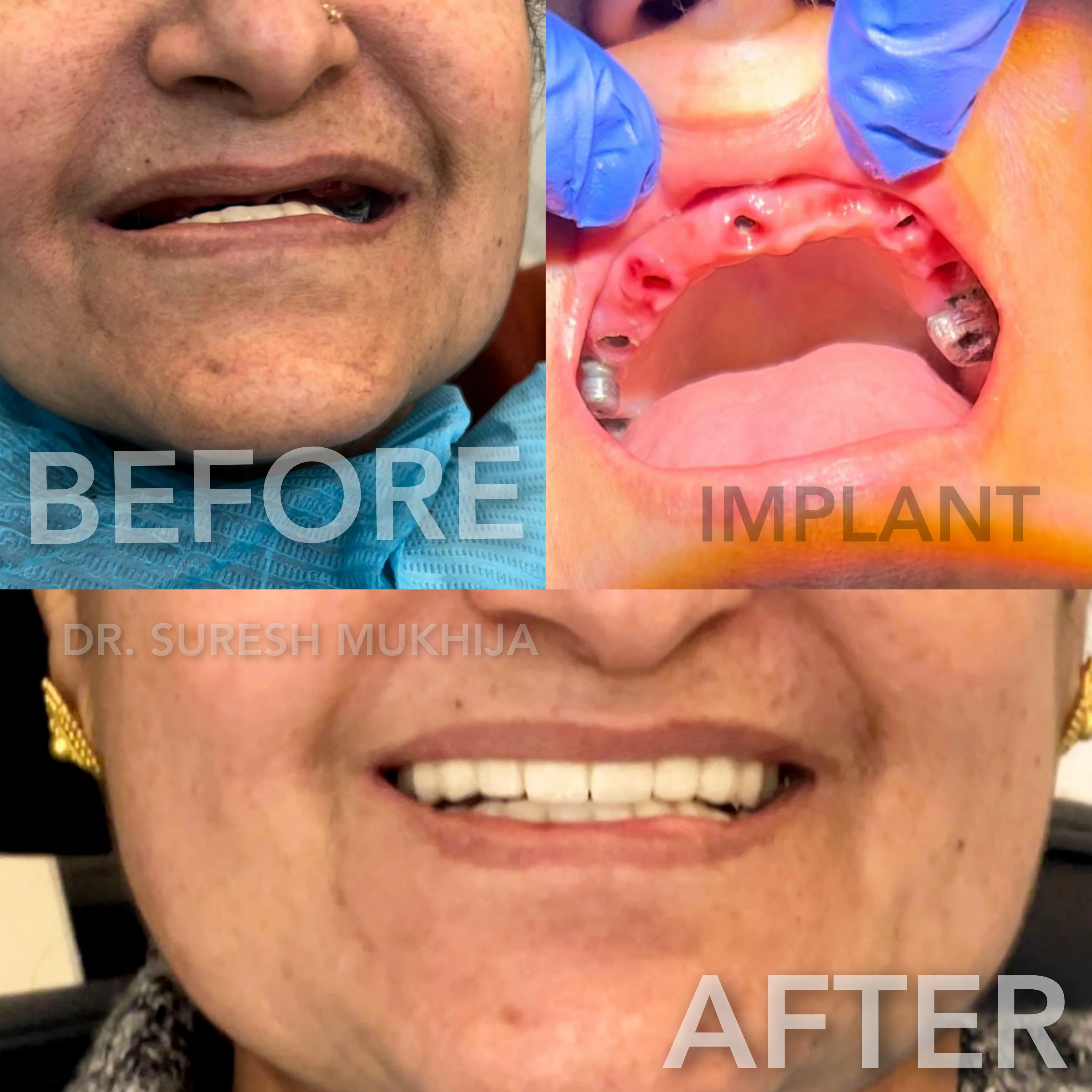 All on 6 Implants