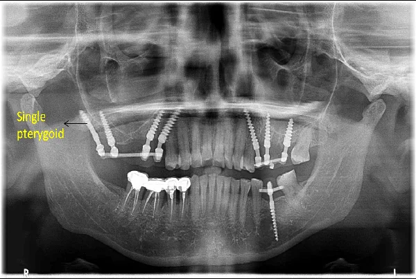 Tuberopterygoid Implants