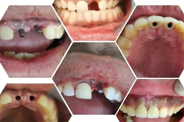 Single Tooth Implants in Karol Bagh, Delhi  Permanent Tooth Replacement  Krisshnaa Dental