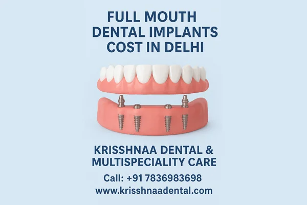 Full Mouth Dental Implants  in Delhi  Krisshnaa Dental  Multispeciality Care