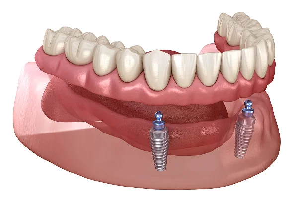 Implant Supported Overdentures in Delhi  Krisshnaa Dental Clinic