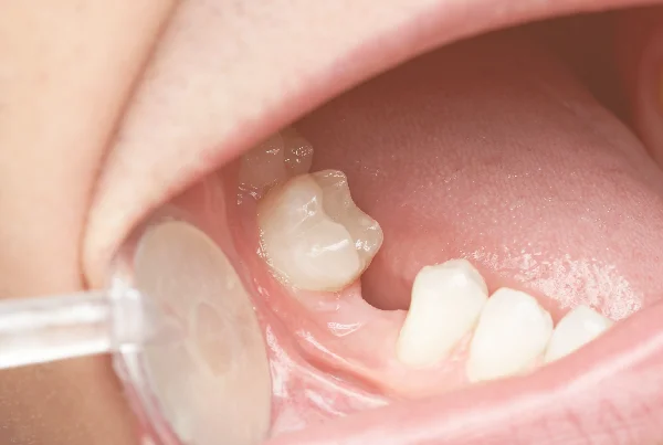 Dental Bone Graft Surgery Cost in Delhi  Krisshnaa Dental
