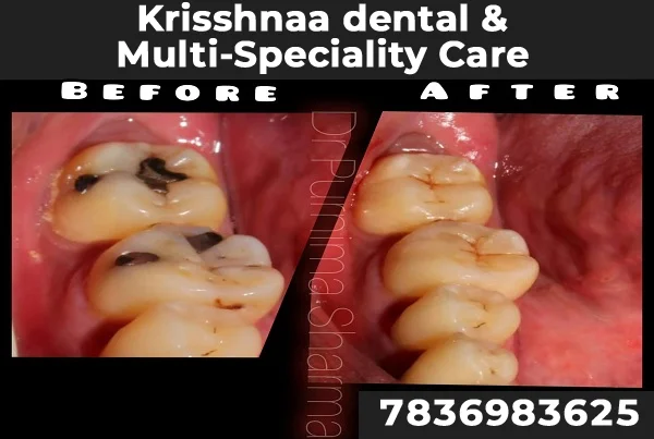Tooth Colour Fillings