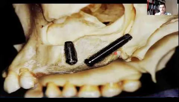 Zygomatic Implants
