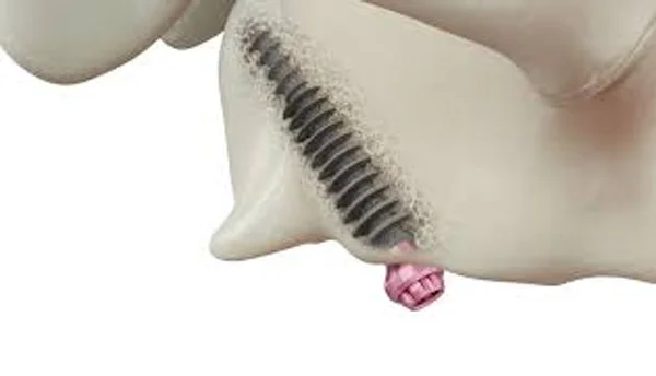 Tuberopterygoid Implants