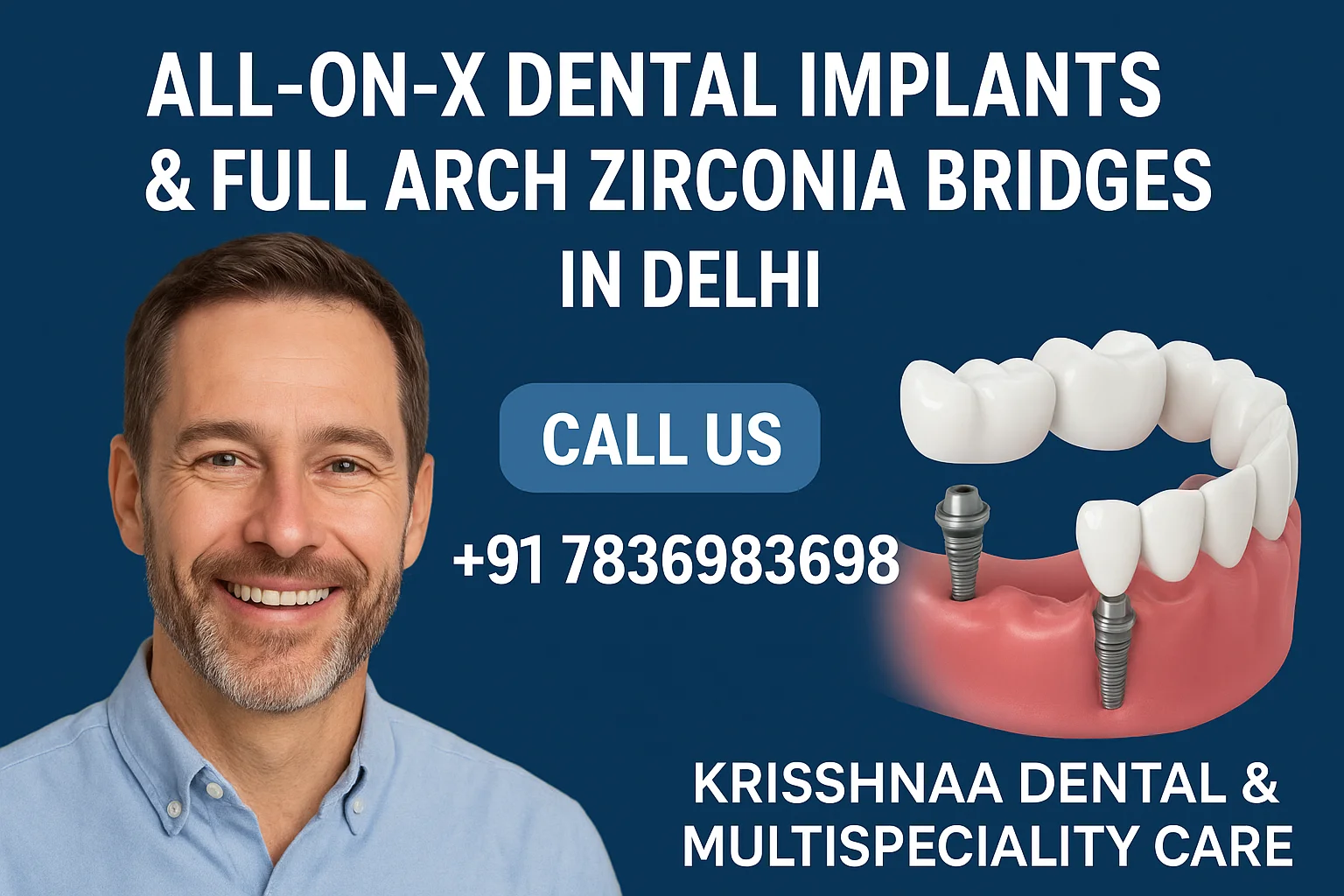 All-on-X Dental Implants & Full Arch Zirconia Bridges in Delhi