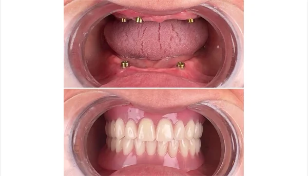 Full Mouth Dental Implants in Delhi