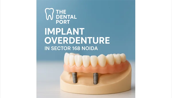 Implant Supported Dentures in Delhi